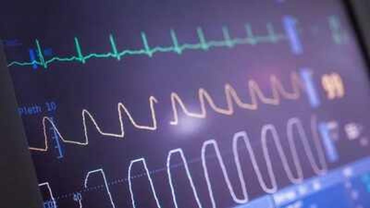 Efficacy of Heart Ablation and Quality of Life Efficacy of Heart Ablation and Quality of Life